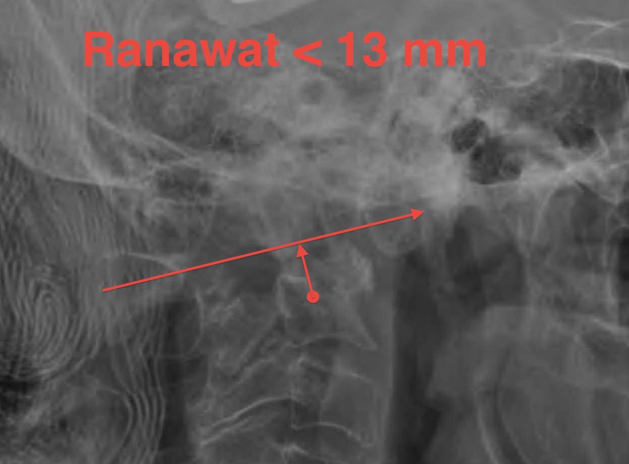 SMO Ranawat Measurement